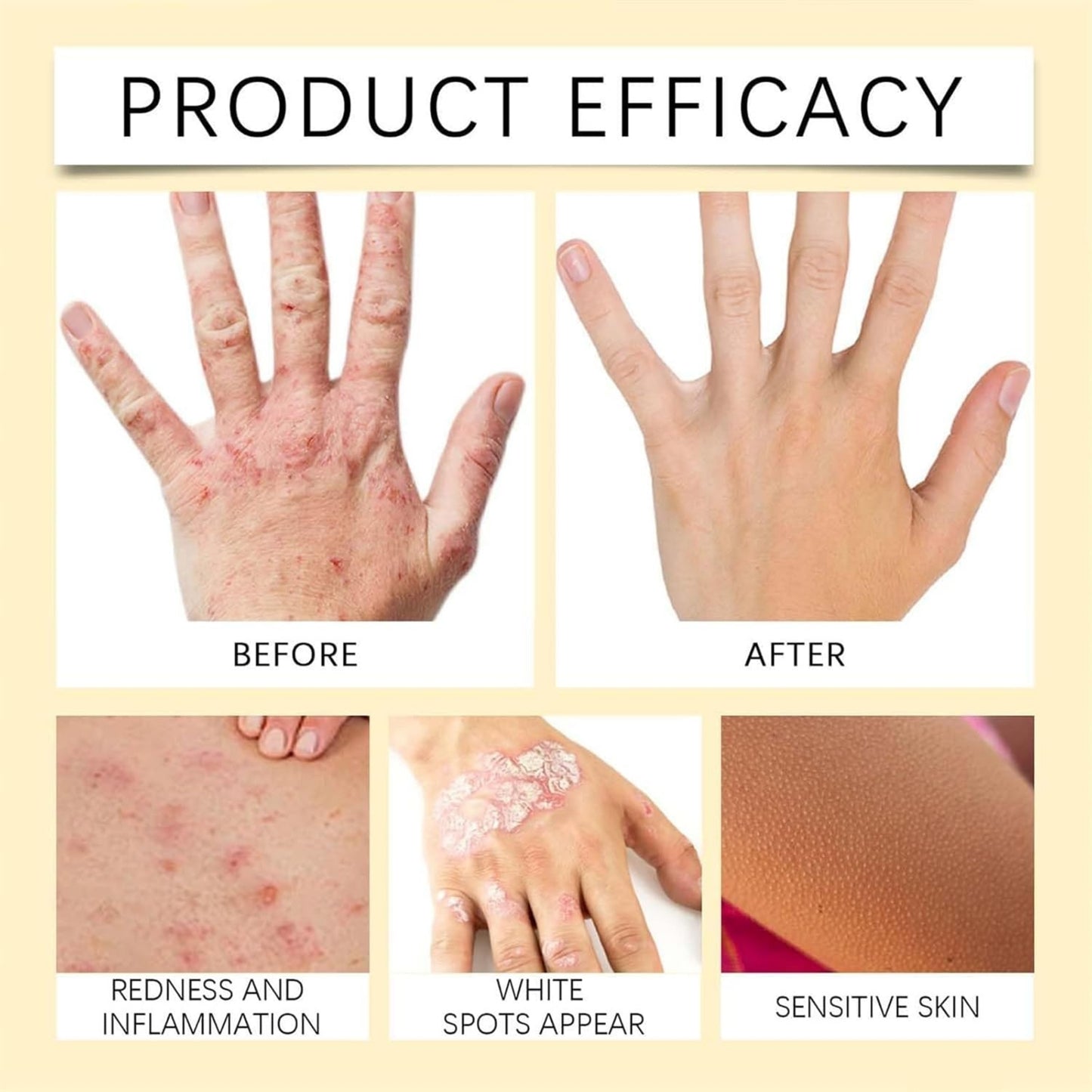 Vitigo Bee Venom Cream | Skin Repair, Hydration & Anti-Irritation