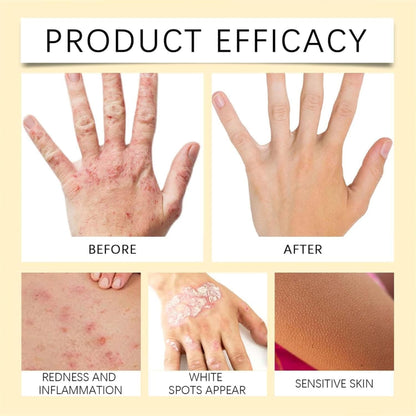 Vitigo Bee Venom Cream | Skin Repair, Hydration & Anti-Irritation